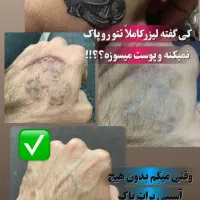 لیزر موهای زائد به مدت محدود فول ۴۹۰|خدمات آرایشگری و زیبایی|ارومیه, |دیوار