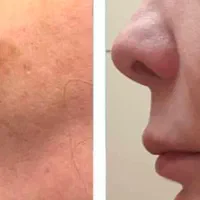 جشنوارهیلیزرCO2فرکشنال(رفعخال،ککومک،جایجوش)|خدمات آرایشگری و زیبایی|زنجان, |دیوار