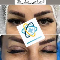 بلفارو پلاستی( جراحی پلک)