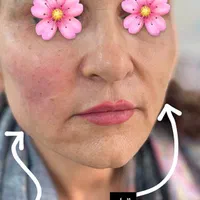 آف ۳۰% ژل بوتاکس بایوفیلر پی ارپی لاغری هایفو لیزر|خدمات آرایشگری و زیبایی|اهواز, کوی باهنر|دیوار