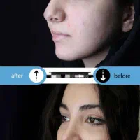 عمل بینی با قالبهای کنترلی|خدمات آرایشگری و زیبایی|تهران, امانیه|دیوار