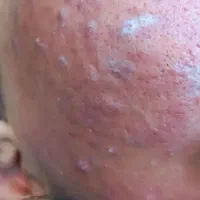 فیشال و پاکسازی صورت در کلینیک