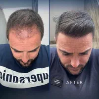 کاشت مو با جدید ترین تکنیک|خدمات آرایشگری و زیبایی|دزفول, |دیوار