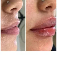 بوتاکس،فیلر،مزوژل باتخفیفی که نمی‌خوای از دست بدی|خدمات آرایشگری و زیبایی|شیراز, میرزاکوچک خان|دیوار