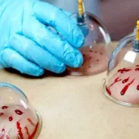 حجامت و بادکش درمانی