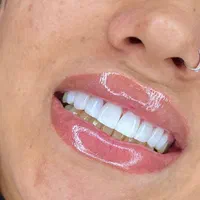 مدل کامپوزیت دندان