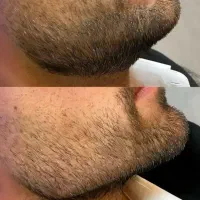 تخفیفات بلک فرایدی ژل و بوتاکس درمطب|خدمات آرایشگری و زیبایی|خرم‌آباد, |دیوار