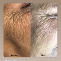 تخفیف فیشیال کلاسیک(رفع جوش سرسیاه)|خدمات آرایشگری و زیبایی|دوگنبدان, |دیوار