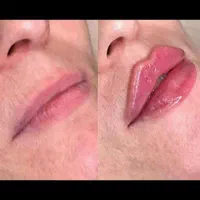 کلاژن مزوتراپی مزونیدلینگ|خدمات آرایشگری و زیبایی|مشهد, کوثر|دیوار