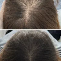 میکرواسکالپ تخصصی با جدیدترین متدvip|خدمات آرایشگری و زیبایی|مشهد, گوهرشاد|دیوار