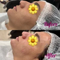 پاکسازی صورت و فیشال تخصصی