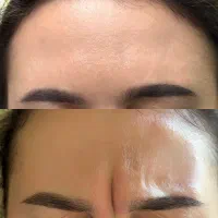 تخفیفات ۵۰درصدی بلک فرایدی بوتاکس