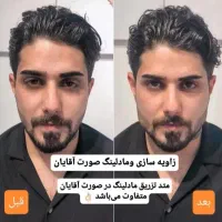 تخفیفات بلک فرایدی ژل و بوتاکس درمطب|خدمات آرایشگری و زیبایی|خرم‌آباد, |دیوار