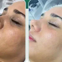 خدمات تخصصی فیشیال و پاکسازی پوست (متناسب با پوست)