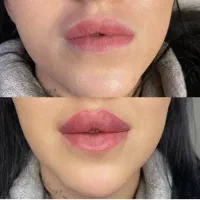 جشنواره ژل لب چانه زاویه جوانسازی بوتاکس لیفت|خدمات آرایشگری و زیبایی|تهران, گیشا|دیوار