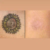 لیزر مو زائد/لیزر تتو/پاک کردن تتو/روشن سازی پوست|خدمات آرایشگری و زیبایی|اصفهان, خلجا|دیوار