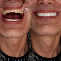 انجام لمینت متحرک دندان