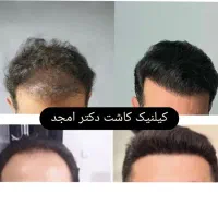 کاشت مو به روش super fue plus  متد ترکیه ۱۲/۵۰۰