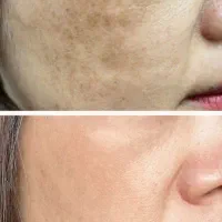 رفع لکه های پوستی تو ۳۰ روز