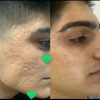 خدمات تخصصی پوست|خدمات آرایشگری و زیبایی|کرج, کوی کارمندان جنوبی|دیوار