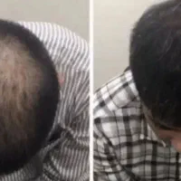 با یه راه ریزشتو نابودش کن