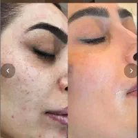فیشیال و آلگاپیل و خالبرداری و هایفرکوئنسی|خدمات آرایشگری و زیبایی|شیراز, شریف‌آباد|دیوار