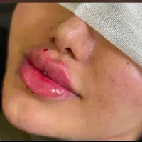 ژل و بوتاکس