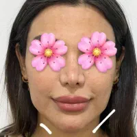 ژل وبوتاکس