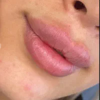 آموزش و خدمات ژل و بوتاکس هر سیسی 590در مطب تخصصی|خدمات آرایشگری و زیبایی|اصفهان, رکن الدوله شرقی|دیوار