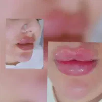 تزریق تخصصی ژل لب تزریق بادی لیفت نخ و چربی|خدمات آرایشگری و زیبایی|خرمشهر, |دیوار