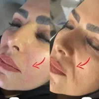 تزریق ژل و بوتاکس و prp صورت و مزو مو|خدمات آرایشگری و زیبایی|سبزوار, جوادیه شرقی|دیوار