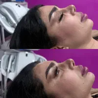 لیزر،کربن،هایفوتراپی ارزان و با کیفیت با هانا