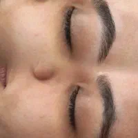 اصلاح تخصصی ابرو و اصلاح درمانی صورت