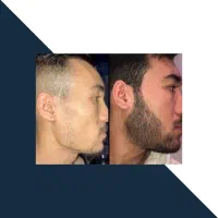 ریشاتو در بیار با هلچ شدن