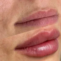 جشنواره فیلر بادی بدن باسن ممنوعه دست پا سی سی۱۸۰|خدمات آرایشگری و زیبایی|شیراز, شریفآباد|دیوار