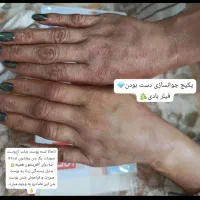 پی ارپی صورت ومو ومزوتراپی صورت ومو تخفیف ویژه|خدمات آرایشگری و زیبایی|کازرون, |دیوار