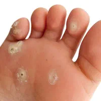 زگیل خال گوشتی و مخچه و...|خدمات آرایشگری و زیبایی|سرپل ذهاب, |دیوار