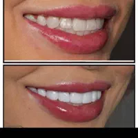 دندانپزشکی عصب کشی ،روکش،ایمپلنت،کامپوزیت|خدمات آرایشگری و زیبایی|بروجرد, |دیوار