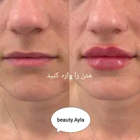 تزریق ژل و بوتاکس و مزو ( جوانسازی و روشن کننده)|خدمات آرایشگری و زیبایی|اهواز, گلستان|دیوار
