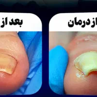 درمان بیماری ناخن ساختمان پزشکان رز پیروزی ۳۸|خدمات آرایشگری و زیبایی|مشهد, چهارچشمه|دیوار