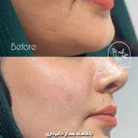 برداشت انواع خال صورت و بدن|خدمات آرایشگری و زیبایی|اهواز, کیانپارس |دیوار