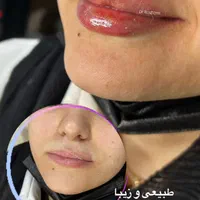 لیزر موهای زاید تزریق بوتاکس وژل  توسط پزشک|خدمات آرایشگری و زیبایی|تالش, هشتپر|دیوار