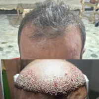 کاشت مو،ریش ،سیبیل،ابرو،پی آرپی ومزوتراپی|خدمات آرایشگری و زیبایی|بوشهر, |دیوار