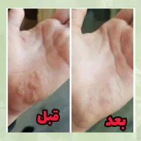 برداشت خال بدون درد و خونریزی بدون بازگشت