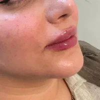 تزریق ژل و بوتاکس در کلینیک زیبایی