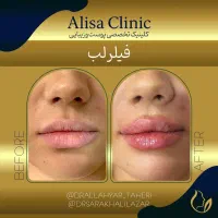 تزریق فیلر زیر چشم|خدمات آرایشگری و زیبایی|تهران, جردن|دیوار