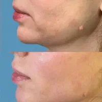 بوتاکس مصپورت.تزریقات وپانسمان و سوراخ کردن گوش|خدمات آرایشگری و زیبایی|اراک, |دیوار