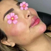 تزریق فیلر|خدمات آرایشگری و زیبایی|الشتر, |دیوار