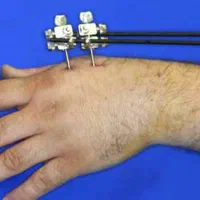 اکسترنال فیکساتور دست