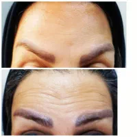 تزریق بوتاکس. مزوتراپی. فیلر|خدمات زیبایی و سلامت|تهران, زاهد گیلانی|دیوار